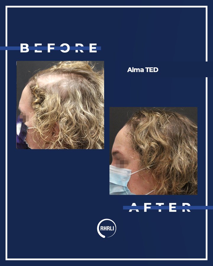 RHRLI before and after post