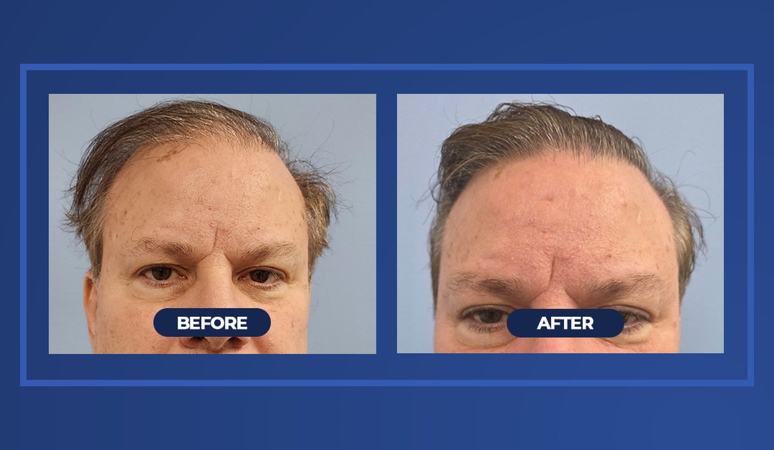RHRLI before and after post